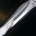 bone-fracture-in-x-ray