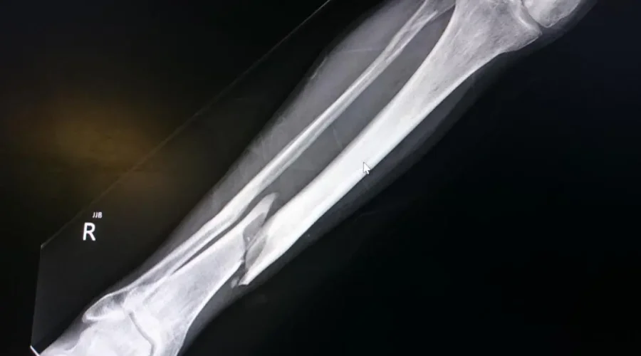 bone-fracture-in-x-ray